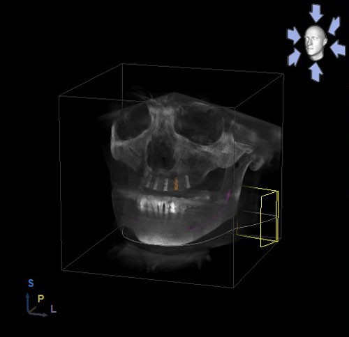 Dreidimensionale Implantatplanung im Oberkiefer