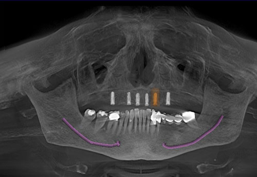 Dreidimensionale Implantatplanung