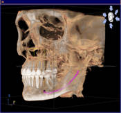 3D-Diagnostik DVT