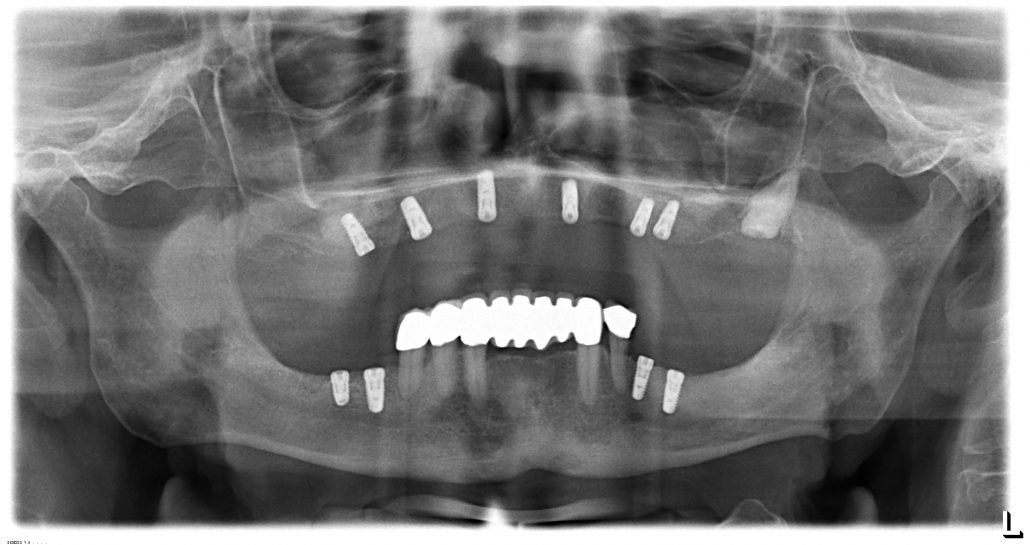 Röntgenbild von Implantaten
